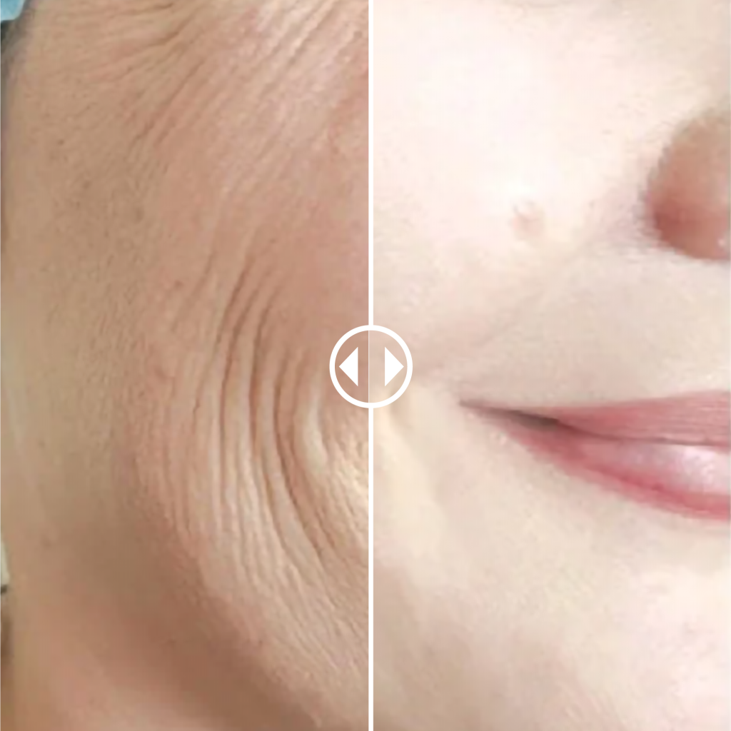 before and after BHHC Aesthetic Clinic in Dubai, Dermatology Clinic & Plastic surgery